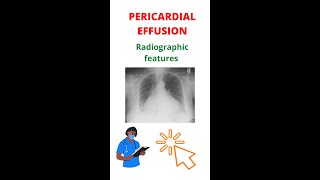 ✅ How To Diagnose Pericardial Effusion shorts xray [upl. by Gorlicki]