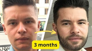 How i Grow Full Beard in Just 3 Months with Minoxidil [upl. by Ardnosac]