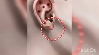 ASMR Treatment and remove for Piercingfor swollen girls ear ear piercing  ASMR video [upl. by Atilemrac524]