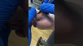 Watch as our Australian podiatrist tackles a big toe callus FootCareDownUnder CallusRemoval [upl. by Eelyr]