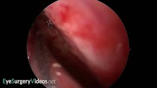 Mucosal flap creation in endo nasal DCR [upl. by Yerffoeg]