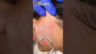 Co2 Laser Treatment at Dr Kasanas Clinic [upl. by Peltz597]