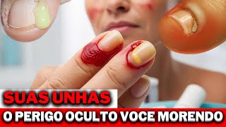 Paroníquia O Perigo Oculto nas Suas Unhas SAUDE PORQUE [upl. by Timofei568]