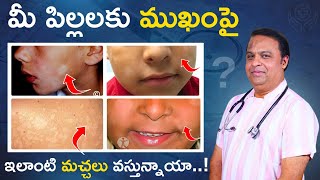 పిల్లల ముఖం పై తెల్ల మచ్చలుwhite patches on baby face in telugu white spots on baby face [upl. by Ainigriv]