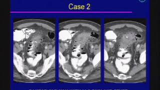 Acute Abdomen Imaging Emergency Radiology [upl. by Ailina65]