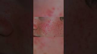 Treatment For Acneമുഖക്കുരു malayalam acne acnetreatment acnescars acneproneskin acnecream [upl. by Ahseet]