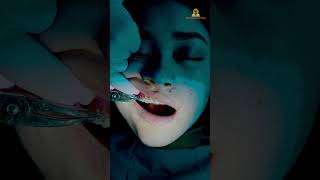 ब्रेसेज़ लगवाने की सही उम्र cavities dentist medical knowledge oralhealthtips dentalcare [upl. by Pratte]