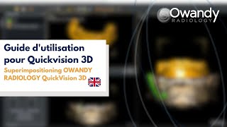 5 SuperimpositioningOWANDY RADIOLOGYQuickVision 3D [upl. by Drona760]