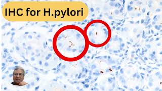 Unusual bacillary and coccoid forms of Helicobacter pylori [upl. by Pejsach696]