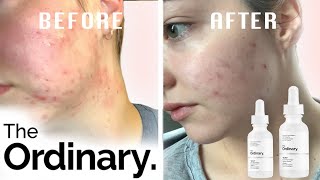 The Ordinary  Honest Review  CURED MY ACNE Here is why this skincare works [upl. by Neve]