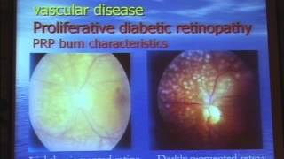 Uses of Lasers in Diabetic Retinopathy [upl. by Gnohc]