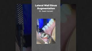 Lateral Wall SInus Augmentation  Simulation HandsOn Session with Dr Saad [upl. by Amand]