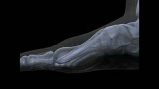 Hallux Limitus  Rigidus Surgery Functional Hallux Limitus Arthritis [upl. by Bondie]