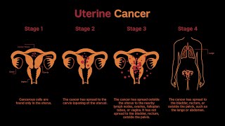 Treatment Choices for Endometrial Cancer by Stage [upl. by Ardnnaed]