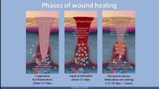 Understanding Scar Tissue [upl. by Otreblig]