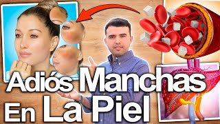 ACLARA TU PIEL AHORA  Cómo Eliminar Las Manchas Oscuras Las Manchas De La Piel Para Siempre [upl. by Yrellih573]