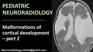 Pediatric Neuroradiology  Malformations of Cortical Development part 2 [upl. by Sivolc]