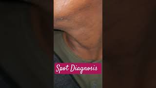 Spot Diagnosis Ear Condition Ear spotdiagnosis Perichondritis [upl. by Cairns75]