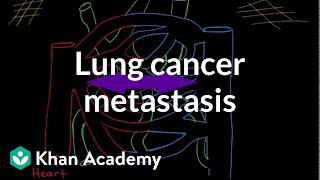 Lung cancer metastasis  Respiratory system diseases  NCLEXRN  Khan Academy [upl. by Imtiaz]