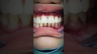 Diastema closure Dokter Gigi Cuspaeni dentalcare doktergigi veneers foryou fyp trending jjj [upl. by Naves]