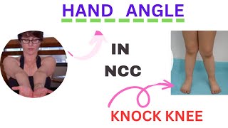 what is hand angle and knock kneeक्या मैं NCC join कर सकता हूं अगर मुझे knock knee हैंshortvideo [upl. by Hubert]