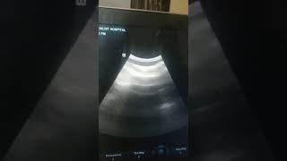 Pre Catheter placement abdominal scan [upl. by Anilam615]