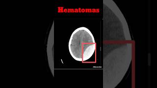 Brain Hematoma CT Brain  EDH  SDH shorts hematoma radiology brainhaemorrhage [upl. by Madid561]