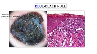 Nodular melanoma  Dr Ketty Peris [upl. by Znarf]