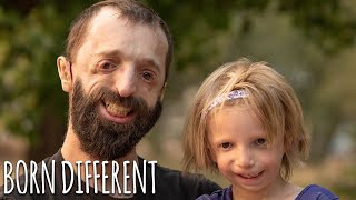 Father And Daughter Battle Rare Facial Condition  BORN DIFFERENT [upl. by Lehcir]