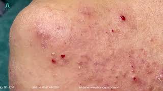 Big Cystic Acne Blackheads Extraction Blackheads amp Milia Whiteheads Removal Pimple Popping [upl. by Hoffert119]