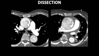 MultiModality Imaging of Acute Aortic Syndromes [upl. by Socrates]