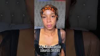 Finally free from an ugly face Full video 👇skincare acnefree affordableskincare beauty free [upl. by Orin]