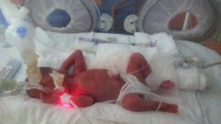 Born at 25 Weeks MicroPreemie Documentary [upl. by Onurb]