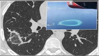 chestradiology signs🛑 1Chest imaging using signs symbols and naturalistic images [upl. by Annoyik]