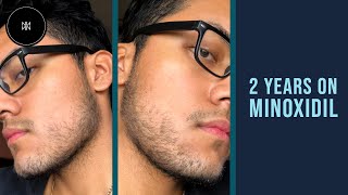 Minoxidil Beard Journey 2 Years [upl. by Calhoun]