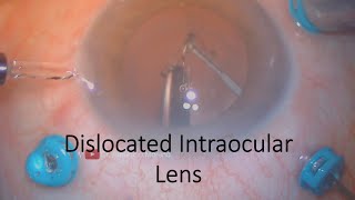 Dislocated Intraocular Lens  Cataract Complications [upl. by Verla]