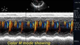 Unusual ventricular septal defect [upl. by Yral]