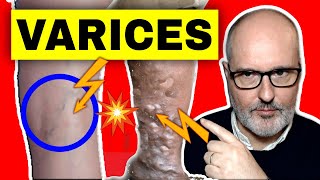 VARICES en las PIERNAS causas síntomas y tratamiento [upl. by Otilegna]