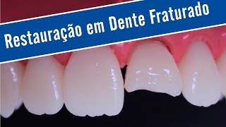 Restauração em Dente Fraturado [upl. by Warila180]