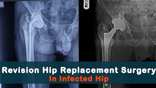 Revision Total Hip Replacement in infected Hip  Patient Testimonial  Dr Rachit Sheth [upl. by Gareri]