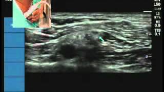 Ultrasound location of Suprascapular nerve [upl. by Chappell946]