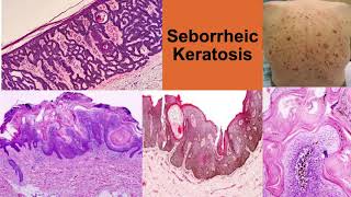 Seborrheic Keratosis [upl. by Kama25]