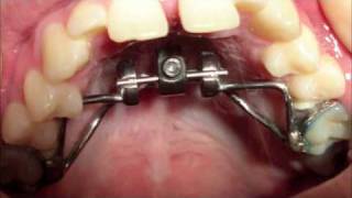 Instructions for the VECS rapid palate expander [upl. by Aerdno]