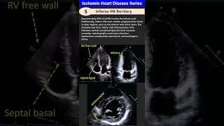 Ischemic Heart Disease 5 Inferior MI [upl. by Hcahsem9]