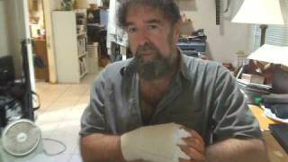 Trigger Finger Surgery PostOP aftermath  explained by Mickey Stein Trigger Finger Part 2 [upl. by Bettye434]