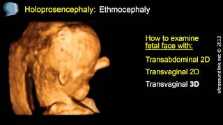 Holoprosencephaly face ethmocephaly 3D ultrasound scan [upl. by Spaulding]