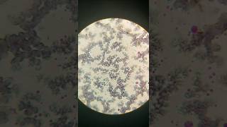 Platelet Clumping During check platelet count in microscope Platelet count in microscope platelet [upl. by Liana]