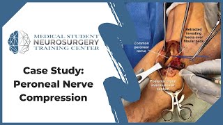 Case Study Peroneal Nerve Compression [upl. by Ainorev]