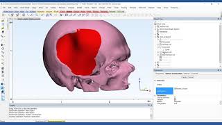 How to Design a PatientSpecific Cranial Plate  Mimics Innovation Suite  Materialise Medical [upl. by Everara]