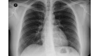 Chest xray  Asbestosis  Pleural calcifications  Round atelectasis [upl. by Ainevuol]